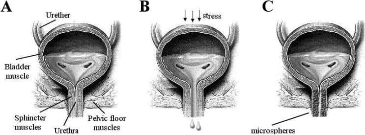 This medical anatomical diagram illustrates the pathophysiology and treatment of stress urinary incontinence (SUI) through three coronal views of the human bladder and urethra (A, B, and C). Diagram A represents normal anatomy and function, showing a healthy bladder muscle, intact ureters, and a closed urethra supported by strong sphincter and pelvic floor muscles. Diagram B depicts the mechanism of stress urinary incontinence, where external 'stress' (indicated by downward arrows) causes involuntary urine leakage through a weakened urethral opening and compromised pelvic floor support. Diagram C demonstrates a therapeutic intervention using urethral bulking agents. It shows the injection of 'microspheres' into the periurethral tissues, which facilitates complete coaptation (closure) of the urethral lumen to prevent leakage. Key labels include the bladder muscle, ureters, urethra, sphincter muscles, and pelvic floor muscles. The illustration is designed for educational use in urology to explain urinary control mechanisms and the clinical application of polymeric microspheres as bulking agents.