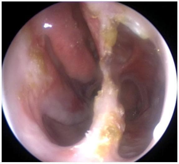 This clinical photograph is an endoscopic view of the internal nasal cavity, demonstrating significant structural and mucosal pathology. The image reveals a wide, single nasal cavity resulting from a large septal perforation and the subsequent loss of septal cartilage. The nasal mucosa appears markedly atrophic, thin, and friable. There is evidence of significant turbinate atrophy, with the inferior and middle turbinates being nearly absent. Extensive crusting is visible throughout the cavity; gray-colored crusts are distributed along the posterior regions toward the rhinopharynx, while yellowish-gold crusts are adherent to the remnants of the septal cartilage. The visual findings are consistent with chronic inflammatory or granulomatous processes, such as granulomatosis with polyangiitis (GPA), illustrating secondary atrophic rhinitis and structural collapse. This image serves as an educational tool for identifying end-stage nasal manifestations of systemic autoimmune diseases.