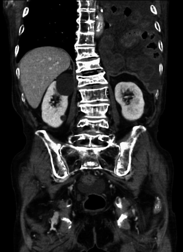 A coronal view of a contrast-enhanced computerized tomography (CT) scan of the thorax and abdomen. The diagnostic image reveals a significant diaphragmatic pathology where loops of the dilated small intestine have herniated through the esophageal hiatus into the left thoracic cavity. Key anatomical findings include a centrally positioned spine, liver in the right upper quadrant, and bilateral kidneys. Notably, the herniated segment of the small intestine demonstrates attenuated contrast enhancement of the intestinal wall, suggesting potential ischemia or vascular compromise. Associated findings include congestion of the mesentery within the thoracic segment, characteristic of strangulated intestinal obstruction. This imaging demonstrates the clinical presentation of a late-onset strangulated hiatal hernia, likely following prior gastric surgery, and highlights the radiological signs of bowel incarceration, such as wall thickening, dilatation, and poor perfusion.