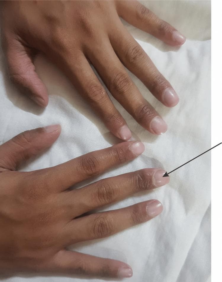 Clinical photograph of the dorsal aspect of both hands, demonstrating bilateral digital clubbing (acropachy). The primary visual findings include an increased convexity of the nail plates and bulbous swelling of the distal phalanges. The Lovibond angle is obliterated, and the nail beds exhibit a soft, spongy appearance characteristic of clubbing. An arrow highlights the prominent curvature of the nail on the right ring finger. The surrounding skin appears normal in texture and pigmentation, with no visible cyanosis. This clinical sign is an important diagnostic indicator for various systemic conditions, including chronic pulmonary diseases, congenital heart disease, or in this specific case, as a manifestation related to ectodermal dysplasia syndromes. The image serves as an educational example for physical examination techniques in dermatology, pulmonology, and internal medicine.