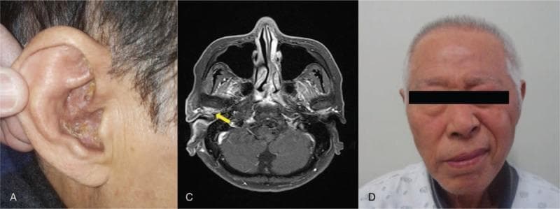 A multi-panel clinical figure documenting a case of Ramsay Hunt syndrome (herpes zoster oticus). Panel A: A clinical photograph of the right auricle showing erythematous, crusting vesicular eruptions and pustules concentrated within the concha and extending to the antihelix, characteristic of a varicella-zoster virus infection in the remission phase. Panel C: An axial T1-weighted Gadolinium-enhanced MRI of the brain at the level of the internal auditory canals. A yellow arrow highlights pathological contrast enhancement in the right external auditory canal and potentially the facial nerve (CN VII) or vestibulocochlear nerve (CN VIII) complex, indicating inflammatory changes. Panel D: A frontal clinical photograph of the patient demonstrating right-sided peripheral facial nerve palsy. Key visible signs include loss of forehead wrinkling, flattening of the nasolabial fold, and a drooping of the right oral commissure (angle of the mouth). Together, these images illustrate the triad of auricular vesicles, otic involvement, and ipsilateral facial paralysis.