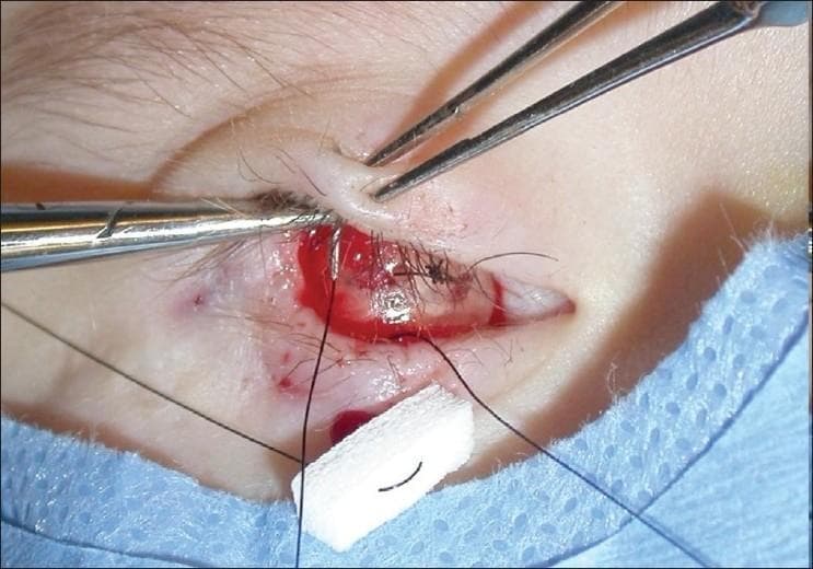 Clinical photograph of a periocular surgical procedure, specifically a suture tarsorrhaphy being performed over a hemisphere expander. The image shows the right ocular region of a patient, likely pediatric, with surgical instruments in use: a needle driver is seen placing a dark, non-absorbable suture through the upper eyelid margin, while fine-toothed forceps (such as Bishop-Harmon or Castroviejo) are used to stabilize the tissue. The palpebral fissure is partially closed by pre-existing sutures. Visible anatomical structures include the superior and inferior eyelids, eyelashes, and the palpebral conjunctiva. Surgical materials present include dark suture threads and a white absorbent gauze bolster or pad near the inferior margin to manage localized bleeding. The procedure is indicated for the management of congenital anophthalmia or microphthalmia, where the tarsorrhaphy provides external support to maintain the position of an orbital volume expander (hydrogel hemisphere) within the conjunctival socket to prevent extrusion and encourage orbital growth.