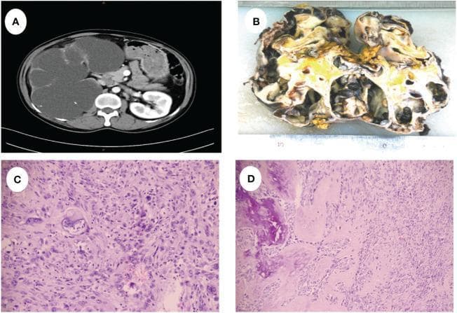 A multi-panel figure illustrating the clinical, gross, and microscopic pathology of sarcomatoid renal cell carcinoma. Panel A is an axial contrast-enhanced CT scan of the abdomen showing massive enlargement of the right kidney with severe hydronephrosis and multiple cystic spaces displacing the liver and midline structures. Panel B shows a gross specimen of the excised right kidney, measuring 20cm x 15cm, demonstrating a multiloculated cystic architecture with areas of necrosis, yellow solid components, and focal hemorrhage. Panels C and D are H&E-stained light microscopy images at varying magnifications. Panel C reveals highly disorganized tumor cells with sarcomatoid changes and significant cellular heterogeneity. Panel D highlights spindle-shaped malignant cells adjacent to areas of heterotopic ossification (bone formation). The composite demonstrates the progression from radiographic findings of a massive renal mass to the histopathological confirmation of a high-grade sarcomatoid malignancy with unusual ossifying features.