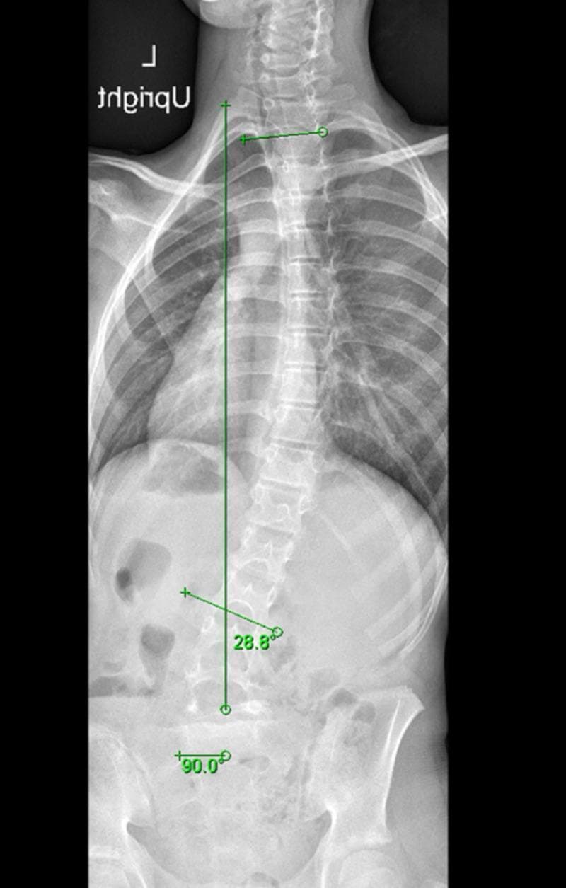 This diagnostic image is a weight-bearing anteroposterior (AP) full-spine radiograph, commonly used for scoliosis evaluation. The X-ray demonstrates a long-segment scoliotic curvature of the spine with a dextroconvex (right-sided) orientation. Anatomical landmarks indicate the curve originates in the upper thoracic spine (T2) and extends through the thoracolumbar junction to the upper lumbar region (L2). Digital annotations show a Cobb angle measurement of 28.8 degrees for this primary curve. Additional quantitative markers include a 90.0-degree angle measurement at the pelvic/lower lumbar interface, evaluating coronal balance or pelvic tilt. The image is critical for diagnosing spinal deformities, assessing vertebral alignment, and monitoring progression in pediatric or adult orthopedic patients. It highlights the absence of significant pedicle rotation at the apex, which is a key clinical indicator in distinguishing between structural and compensatory or non-structural scoliotic curves secondary to conditions like spondylolisthesis.