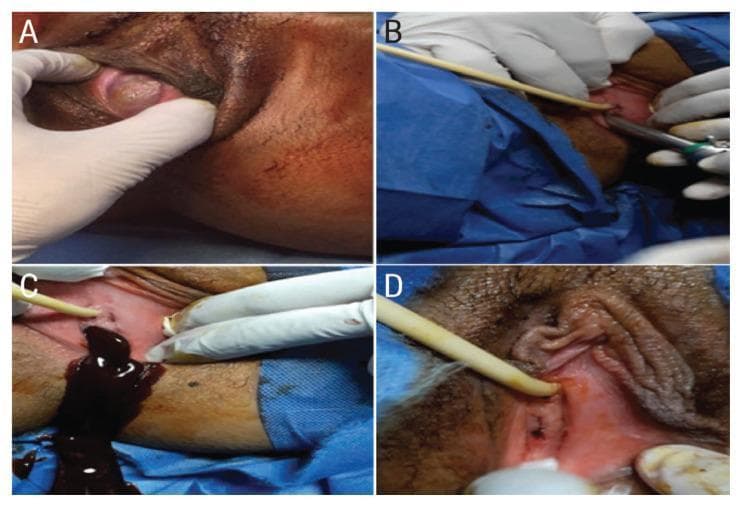 A series of four clinical photographs (A-D) documenting the surgical management of an imperforate hymen in a postpubertal patient. (A) Preoperative view showing a distended, bulging hymenal membrane with characteristic dark, bluish discoloration caused by hematocolpos (accumulated menstrual blood). (B) Intraoperative image demonstrating the controlled perforation of the hymenal membrane using a 10 mm laparoscopy trocar tip. (C) Clinical photograph capturing the drainage of retained menses through the trocar sleeve; the fluid is dark, thick, and viscous, consistent with long-term retention. (D) Postoperative follow-up image displaying the results of a reconstructive technique that preserved the integrity and patency of the annular hymenal ring while avoiding restenosis. These images illustrate the diagnostic presentation of primary amenorrhea due to outflow obstruction and a modified surgical approach for hymenotomy that aims to maintain anatomical structure.