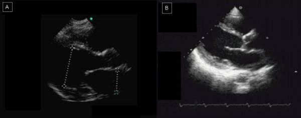 This diagnostic comparison displays two echocardiographic images (Parasternal Long-Axis View) of a patient with dilated cardiomyopathy. Image A was acquired using a Hand-Held Device (HHD), while Image B was obtained using Standard Echocardiography (SED). Both images demonstrate clear hallmarks of dilated cardiomyopathy, specifically a significantly enlarged and rounded left ventricle (LV) with thinning of the ventricular walls. Anatomical structures including the left atrium, mitral valve, and LV outflow tract are visible in both. The comparison highlights differences in imaging performance: Image A (HHD) shows lower spatial resolution with grainier texture and less defined endocardial borders, and includes calipers (dotted lines) measuring ventricular dimensions. Image B (SED) offers superior contrast and detail of the myocardium and valvular structures. This side-by-side comparison serves as an educational tool for evaluating the diagnostic utility of portable ultrasound versus high-end systems in identifying severe structural heart disease and chamber dilation.