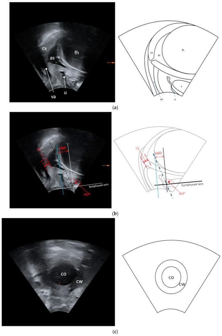 This composite educational resource demonstrates transperineal ultrasound (TPU) assessment during labor, featuring side-by-side sonographic images and corresponding schematic diagrams in sagittal and transverse planes. Section (a) illustrates maternal and fetal anatomy in the sagittal plane, identifying the symphysis (s), urethra (u), vagina (va), cervix (cx), amniotic sac (as), and fetal head (fh). Section (b) details objective labor progression measurements including the angle of progression (AoP), head-symphysis distance (HSD), and cervical length (CL), using the long symphyseal axis as a geometric reference. Section (c) provides a transverse view of the birth canal, clearly delineating the cervical opening (co) and the surrounding cervical wall (cw), which are essential for quantifying cervical dilation (CD) and wall thickness. This material serves as a clinical guide for using non-invasive ultrasound imaging to monitor fetal descent and cervical effacement during the first and second stages of labor.