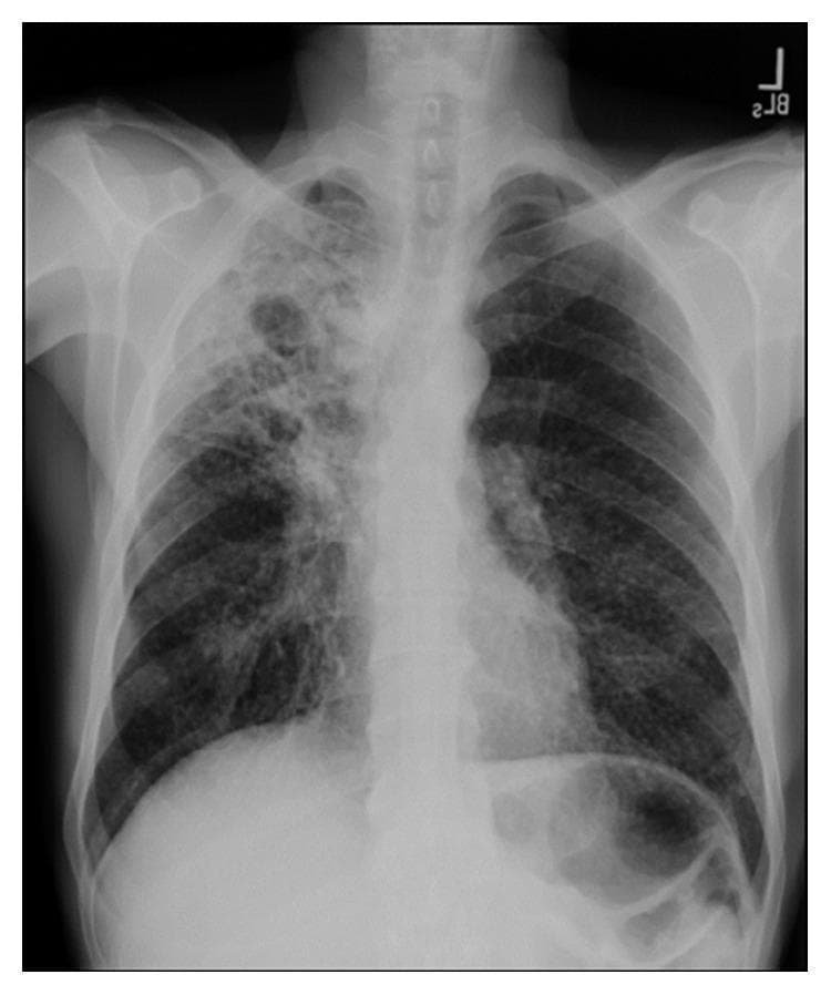 This diagnostic image is a posterior-anterior (PA) chest X-ray demonstrating significant pulmonary pathology. The primary finding is a large, prominent cavitary opacity localized in the right upper lobe. The lesion displays a thick, irregular wall with a central lucency, indicating an air-filled cavity within a region of parenchymal consolidation. Surrounding the main cavity, there are heterogeneous, patchy infiltrates and smaller areas of increased density throughout the right upper and middle lung fields. The left lung appears relatively clear in comparison, though subtle reticulonodular markings are present. The trachea is midline, and the cardiomediastinal silhouette appears within normal limits for this projection. This visual presentation is highly characteristic of secondary (reactivation) tuberculosis or a necrotizing fungal pneumonia. The image serves as a classic educational example of cavitary lung disease, illustrating the destruction of lung parenchyma and the formation of gas-filled spaces often associated with Mycobacterium tuberculosis infection.