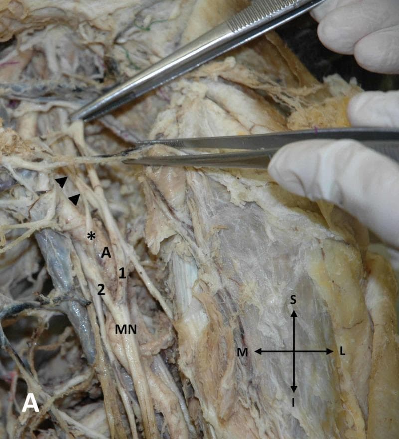 This clinical photograph captures a detailed anatomical dissection of the left axillary region in a cadaver, specifically highlighting an anatomical variation of the brachial plexus. The image displays the axillary artery (A) and the formation of the median nerve (MN). A key anatomical variant is demonstrated: an additional lateral root of the median nerve (marked with an asterisk) originating from the anterior division of the middle trunk (indicated by arrowheads). This additional root is seen crossing anterior to the axillary artery to fuse with the medial root (2), forming a distinct neural loop. The standard lateral root (1) is also visible, contributing to the main trunk of the median nerve distal to the variant fusion. Directional indicators (S: Superior, I: Inferior, M: Medial, L: Lateral) provide orientation for the neurovascular structures. Surgical forceps are used to retract and highlight the specific nerves and their junctions. This image is an important educational resource for understanding neurovascular variations in the axilla, which have significant clinical implications for surgical approaches and regional anesthesia of the upper limb.