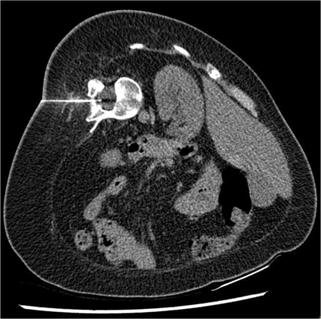 An axial non-contrast CT scan of the abdomen and lower lumbar region, demonstrating a CT-guided interventional procedure. The image shows a spinal needle traversing the paraspinal musculature and subcutaneous fat from a left-sided approach. The needle tip is precisely positioned within the spinal canal, targeted for an intrathecal injection (nusinersen) in a patient with Spinal Muscular Atrophy (SMA). The spinal anatomy displays significant rotation and distortion consistent with severe scoliosis. Visible internal landmarks include a vertebral body, the spleen in the right aspect of the image (due to patient positioning), and loops of bowel with speckled fecal content. The image illustrates the standard protocol for neuraxial access in complex anatomical scenarios where traditional palpation-based lumbar puncture is not feasible due to skeletal deformities. Key features include the visualization of the needle trajectory, the clear identification of the target intrathecal space, and the surrounding soft tissue and osseous structures.