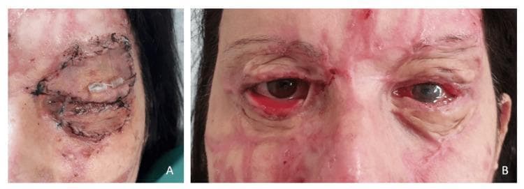 Two-panel clinical photograph illustrating the surgical management and complications of chemical burns to the face and eyelids. Image A shows the left eye of a 45-year-old patient following an initial reconstructive procedure for a severe sulfuric acid burn. Full-thickness skin grafts have been applied to both the upper and lower eyelids. The grafts are secured with visible peripheral sutures, and a clear plastic bolster (stent) is positioned on the upper eyelid to minimize graft contraction. The surrounding periorbital tissue shows significant erythema and hypertrophic scarring. Image B displays a later clinical stage showing bilateral eyelid malposition. The right lower eyelid exhibits severe cicatricial ectropion, characterized by the outward eversion of the eyelid margin and significant exposure of the hyperemic, inflamed palpebral conjunctiva. The left eye shows corneal opacity and further scarring. Extensive, multi-tonal facial scarring with 'trickle' patterns characteristic of liquid chemical burns is visible across the forehead, cheeks, and periorbital regions, demonstrating the long-term sequelae and complexity of managing cicatricial deformities following acid injuries.