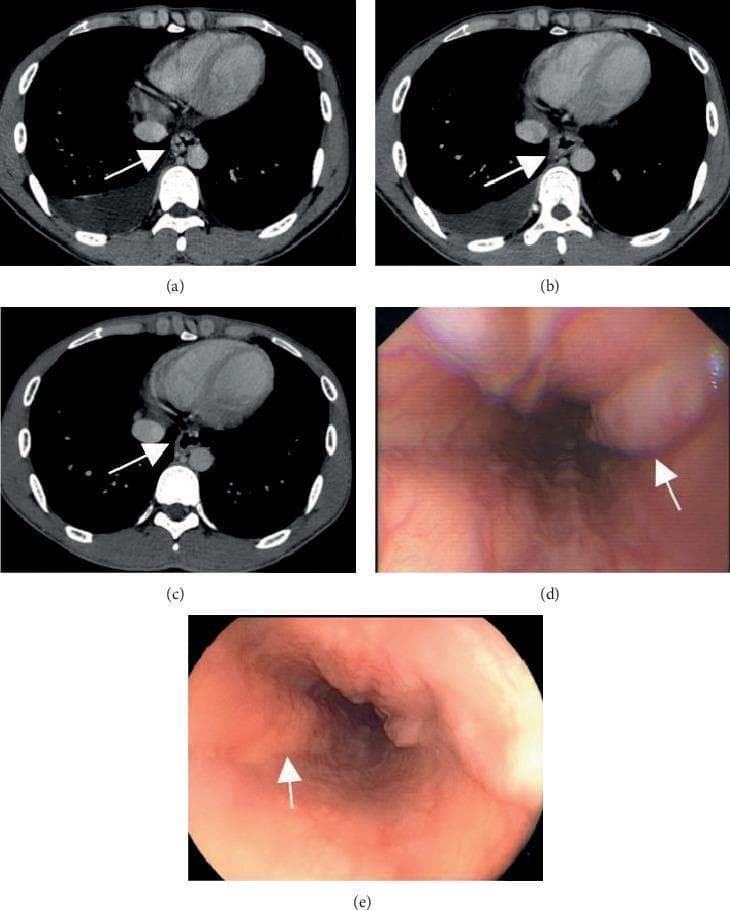 This composite figure demonstrates the efficacy of endoscopic band ligation (EBL) for severe esophageal varices through longitudinal diagnostic imaging and endoscopy. Panes (a), (b), and (c) are axial contrast-enhanced CT scans at the level of the distal esophagus. Image (a) shows the baseline state with prominent, dilated esophageal varices (arrowed). Sequential scans at 1 week (b) and 1 month (c) post-treatment demonstrate progressive attenuation and reduction in the diameter of the variceal vessels. Panes (d) and (e) provide direct endoscopic visualization of the esophageal lumen. Image (d) illustrates baseline severe esophageal varices characterized by large, tortuous protrusions into the lumen (arrowed). Image (e), captured 1 month after endotherapy, shows a significant therapeutic response, with a reduction in variceal size and a smoother, less congested esophageal mucosal lining. This comparison highlights the role of both cross-sectional imaging (CTPV) and direct endoscopy in monitoring treatment outcomes for portal hypertension complications.