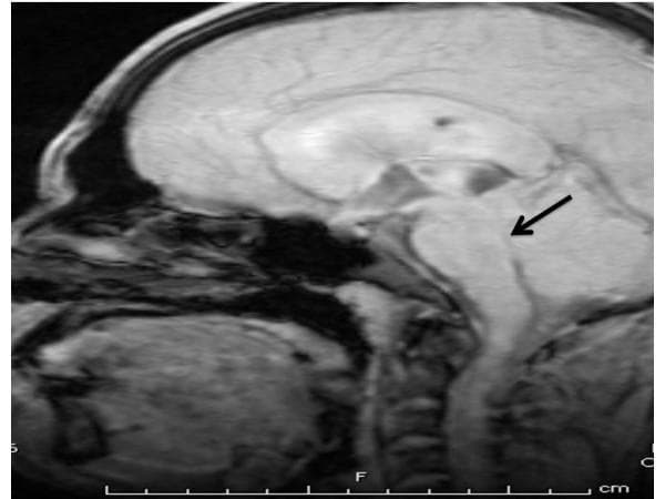 Midsagittal T1-weighted MRI of the brain demonstrating features of obstructive hydrocephalus. The image shows significant dilation of the lateral ventricles and the third ventricle. A black arrow points to the aqueduct of Sylvius (cerebral aqueduct) located between the third and fourth ventricles, indicating the site of aqueductal stenosis. The narrowing at this level leads to the proximal ventricular enlargement seen. The surrounding brainstem, including the pons and medulla, as well as the cerebellum, are visualized. This radiological finding is clinically significant for diagnosing non-communicating hydrocephalus, which in this context is associated with neurocysticercosis causing physical obstruction of the cerebrospinal fluid (CSF) flow path. The image provides a clear anatomical reference for identifying ventricular proportions and midbrain landmarks in neurosurgical and neuroradiological education.