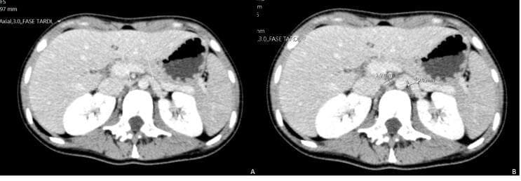 This diagnostic image consists of two side-by-side axial contrast-enhanced abdominal CT scans (labeled A and B) demonstrating the classic radiographic features of Nutcracker Syndrome. The images show the anatomical relationship between the abdominal aorta, the superior mesenteric artery (SMA), and the left renal vein. In image A, the left renal vein is seen passing through the narrow aortomesenteric angle. Image B provides quantitative measurements of this compression: the caliber of the left renal vein is significantly reduced to 3.0 mm within the aortomesenteric space, while the pre-stenotic segment of the vein near the renal hilum is dilated to 9.0 mm. Key anatomical landmarks visible include the liver (right), stomach (left), and both kidneys flanking the spine. This comparison highlights the vascular 'nutcracker' effect where the SMA compresses the left renal vein against the aorta, potentially leading to renal venous hypertension and associated clinical symptoms.