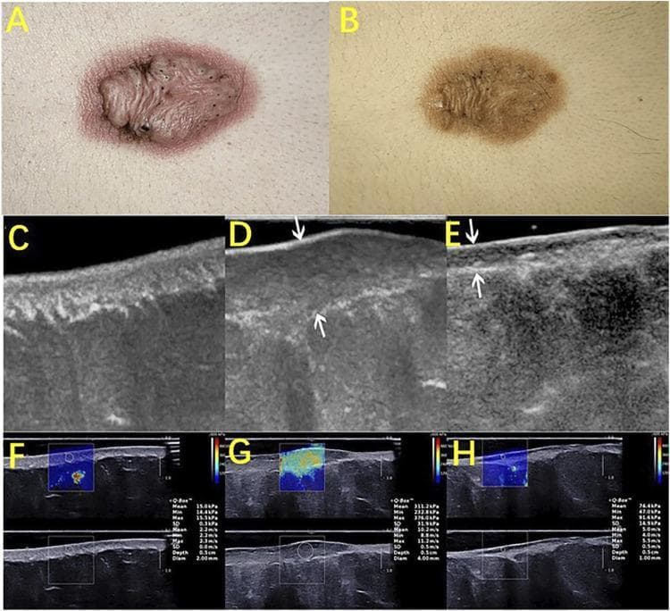 This composite figure illustrates the application of High-Frequency Ultrasound (HFUS) and Shear Wave Elastography (SWE) in monitoring keloid treatment efficacy. Panels A and B provide clinical photographs of a keloid before and after intralesional steroid injection, showing a reduction in erythema and lesion height. Panels C, D, and E display longitudinal B-mode ultrasound images comparing normal skin (C), a pretreated keloid (D), and a post-treated keloid (E). In panel D, the pretreated keloid appears as a thickened, hypoechoic elliptical area in the dermis. Panel E shows a significant reduction in scar thickness and a shift in echo texture toward normal dermal patterns following treatment. Panels F, G, and H present corresponding elastography maps. Normal skin (F) and post-treated tissue (H) exhibit relatively uniform blue-to-green color distributions, indicating lower stiffness. In contrast, the pretreated keloid (G) shows a heterogeneous color map with prominent yellow-red areas, signaling increased Young’s modulus and tissue stiffness. The educational focus is on using non-invasive imaging to objectively quantify changes in scar morphology and mechanical properties (elasticity) during therapy.
