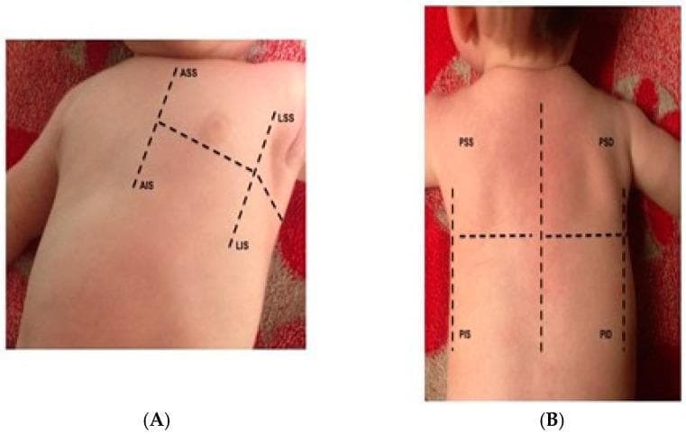 Educational clinical photograph demonstrating the standardized thoracic scanning zones for pediatric Lung Ultrasound (LUS). The image consists of two panels showing an infant's chest and back with superimposed dashed lines defining anatomical quadrants.
Panel A illustrates the anterior and lateral hemithorax. The anterior superior (ASS) and anterior inferior (AIS) zones are separated from the lateral superior (LSS) and lateral inferior (LIS) zones. The divisions represent standard LUS protocols delineated by the parasternal, anterior axillary, and posterior axillary lines.
Panel B shows the posterior hemithorax divided into four quadrants by vertical and horizontal dashed lines. The regions are labeled: PSS (Posterior Superior Sinister/Left), PSD (Posterior Superior Dexter/Right), PIS (Posterior Inferior Sinister/Left), and PID (Posterior Inferior Dexter/Right).
This diagram serves as a clinical guide for systematically evaluating pulmonary areas for conditions such as lung congestion, pleural effusion, or pneumothorax in pediatric patients. It emphasizes a structured approach to ensure comprehensive coverage of the lung fields during ultrasound examination.