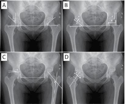 This composite of four pelvic anteroposterior (AP) radiographs (labeled A-D) illustrates standard orthopedic measurements used to evaluate hip joint morphology, specifically for diagnosing hip dysplasia and femoroacetabular impingement (FAI).
Panel A demonstrates Wiberg's center-edge (CE) angle, calculated from the center of the femoral head to the lateral acetabular rim against a vertical reference, and Sharp's angle, measuring acetabular inclination using the horizontal teardrop line. Panel B displays the acetabular depth-to-width ratio and the femoral head extrusion index (a:b ratio), quantifying the degree of femoral head coverage by the acetabulum. Panel C depicts the acetabular roof obliquity angle (Tonnis angle) and the caput-collum-diaphyseal (CCD) angle, which assesses the alignment between the femoral shaft and neck. Panel D illustrates Murray's femoral head ratio, focusing on the femoral head's position relative to the neck axis.
Key anatomical landmarks identified include the femoral heads, acetabular rims, iliac wings, teardrop lines, and greater/lesser trochanters. These quantitative parameters are essential for evaluating joint stability, coverage, and proximal femoral geometry in clinical radiology and orthopedics.