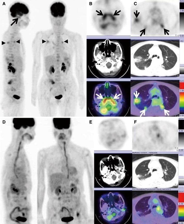 Diagnostic imaging series comprising FDG PET/CT scans of a 65-year-old patient with Granulomatosis with Polyangiitis (GPA/Wegener's). Panel A (MIP image) and Panels B-C (axial PET, CT, and fused PET/CT) show the baseline state with marked metabolic activity. Key findings include intense FDG uptake in the nasopharynx and bilateral auditory tubes (max SUV 4.30), and hypermetabolic nodular shadows in both lungs (max SUV 3.41). These findings correlate with elevated MPO-ANCA and PR3-ANCA titers. Panels D, E, and F display follow-up imaging five months post-treatment, illustrating a complete metabolic response. The repeat MIP and axial fused images show the resolution of previously seen hypermetabolism in the nasal mucosa and pulmonary nodules (max SUV reduced to 1.11–1.41), coinciding with the normalization of ANCA titers. This comparison illustrates the utility of FDG PET/CT in monitoring treatment response and disease activity in systemic vasculitis affecting the upper and lower respiratory tracts.