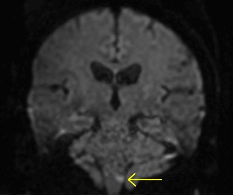 A coronal slice of a brain MRI using Diffusion-Weighted Imaging (DWI). The image displays the cerebrum, ventricular system, and posterior fossa structures, including the brainstem and cerebellum. A yellow arrow points to a localized focal area of high signal intensity (restricted diffusion) measuring approximately 4 mm in the left lateral medulla. This hyperintense lesion is characteristic of an acute ischemic infarct within the vascular territory of the posterior inferior cerebellar artery (PICA). The find represents Wallenberg syndrome (lateral medullary syndrome) pathology. The background shows moderate cortical and central atrophy, consistent with chronic ischemic changes or age-related involution. This diagnostic image is intended for educational use in neurology and radiology to demonstrate small-vessel stroke localization in the brainstem.