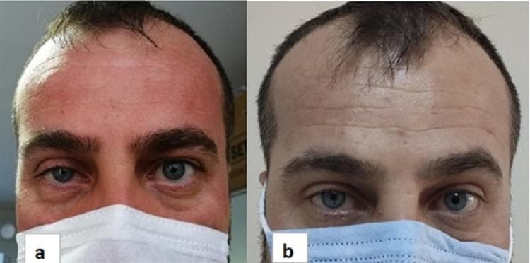 Clinical photograph comparing the ocular features of a patient with right-sided Horner's syndrome at two time points: one month (a) and six months (b) post-surgery. Figure (a) clearly demonstrates the classic triad of miosis (constricted right pupil) and partial ptosis (drooping of the right upper eyelid) when compared to the left eye. Figure (b) shows the progression after six months of recovery, where there is a subtle improvement in the right upper eyelid position (reduction in ptosis) and a decrease in the degree of anisocoria (pupil size discrepancy). The image serves as a diagnostic visual for neurological and ophthalmological assessment, illustrating the clinical manifestation of sympathetic pathway disruption and its subsequent partial resolution over time. The anatomical focus is on the periocular region and pupillary symmetry, which are key indicators for evaluating brachial plexus or cervical sympathetic chain pathologies.