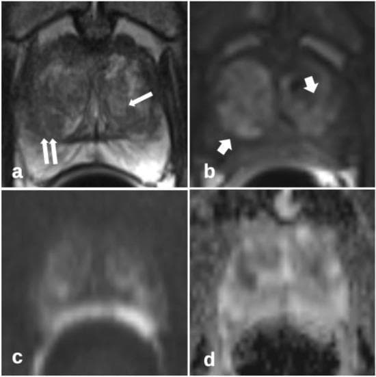 This four-panel diagnostic image displays multiparametric magnetic resonance imaging (mpMRI) of the prostate in a 57-year-old patient with benign prostatic hyperplasia (BPH). Panel (a) is a T2-weighted axial image showing typical BPH nodules in the transition zone (TZ) and marked biopsy traces indicated by long arrows as linear, hypointense signal alterations. Panel (b) illustrates a T1-weighted early-phase dynamic perfusion image where short arrows highlight a non-specific heterogeneous perfusion pattern within the transition zone, lacking marked asymmetry or focal high signal intensity. Panel (c) shows diffusion-weighted imaging (DWI) at a high b-value (b=1400), and panel (d) presents the corresponding apparent diffusion coefficient (ADC) map. These sequences collectively demonstrate the absence of suspicious restricted diffusion or focal enhancement characteristic of prostate carcinoma. The educational focus is on distinguishing the symmetric, heterogeneous enhancement patterns of benign transition zone hyperplasia from the focal, asymmetric, and homogeneous patterns typically associated with malignant lesions according to PI-RADSv2.1 criteria.
