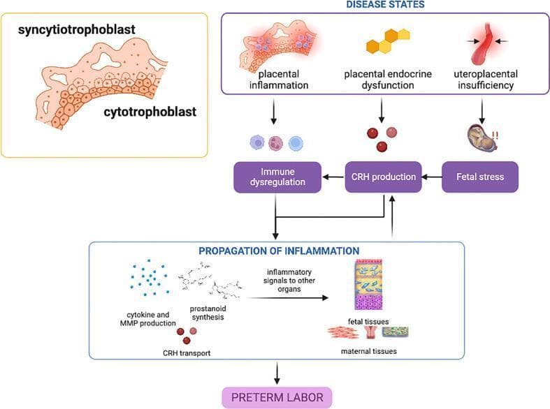 A pathophysiology diagram illustrating the disease states in the placenta that contribute to spontaneous preterm birth (sPTB). The top section identifies three primary placental 'Disease States': placental inflammation (represented by inflamed trophoblast tissue), placental endocrine dysfunction (depicted by hexagonal cellular units), and uteroplacental insufficiency (illustrated by a constricted blood vessel). These states lead through a central mediation layer involving immune dysregulation, CRH (Corticotropin-Releasing Hormone) production, and fetal stress. These pathways converge into a 'Propagation of Inflammation' stage, which details the biochemical cascade including cytokine and MMP production, prostanoid synthesis, and CRH transport. This cascade generates inflammatory signals that target both fetal and maternal tissues (including the decidua and myometrium). The flowchart concludes with the clinical outcome: Preterm Labor. An inset on the left provides anatomical context of the syncytiotrophoblast and cytotrophoblast layers. The diagram highlights the predominant roles of the NF-κB pathway and CRH-mediated feed-forward mechanisms in gestational tissue inflammatory activation.