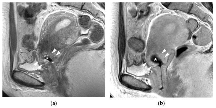 This diagnostic image consists of two sagittal MRI views of the female pelvis in a 42-year-old patient with IA1 cervical cancer, demonstrating post-conization changes. Panel (a) is a T2-weighted sagittal image showing a characteristic cone-shaped tissue defect (marked with an asterisk) at the exocervix following a cervical biopsy. Surrounding the defect, there are poorly demarcated hyperintense regions (indicated by arrowheads) representing post-biopsy inflammation within the cervical stroma. Panel (b) is a delayed contrast-enhanced sagittal image of the same region. It reveals a hematoma (marked with an asterisk) filling the biopsy defect, which appears hypointense compared to the surrounding tissue. The arrowheads in this panel highlight a poorly demarcated zone of enhancement surrounding the defect, further illustrating reactive inflammation. These images are used in oncological radiology to differentiate post-surgical changes, such as inflammation and hematoma, from residual invasive tumor, which in this case was not detected. The visual focuses on gynecological oncology and the utility of multi-sequence MRI in staging and post-operative assessment of early-stage cervical malignancies.