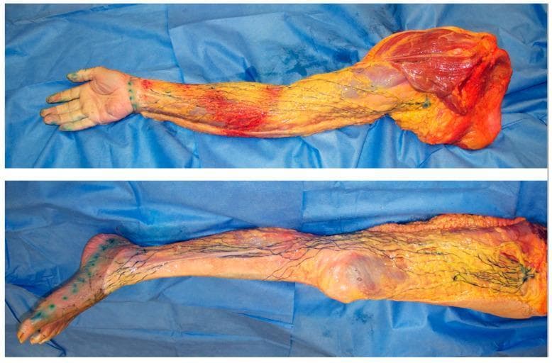This composite clinical photograph displays two dissection specimens of the upper (top) and lower (bottom) human limbs, illustrating the superficial lymphatic system through a microinjection technique. The specimens have had the skin and superficial adipose tissue removed to reveal the superficial lymph-collecting vessels, which have been injected with blue acrylic dye for visualization. In the upper limb, the blue-stained lymphatic vessels are seen originating from the hand and extending proximally toward the axillary region, where a white arrow identifies a sentinel lymph node. In the lower limb, vessels traverse from the foot and lower leg toward the groin, with a black arrow marking a sentinel node in the superficial inguinal region. The vessels appear as fine, independent, dark blue branching pathways within the subcutaneous layer, demonstrating a lack of extensive interconnections or network formation. These images serve as an anatomical reference for understanding normal lymphatic drainage, lymphosome territories, and the baseline pathways involved in conditions like lymphedema or cancer metastasis.