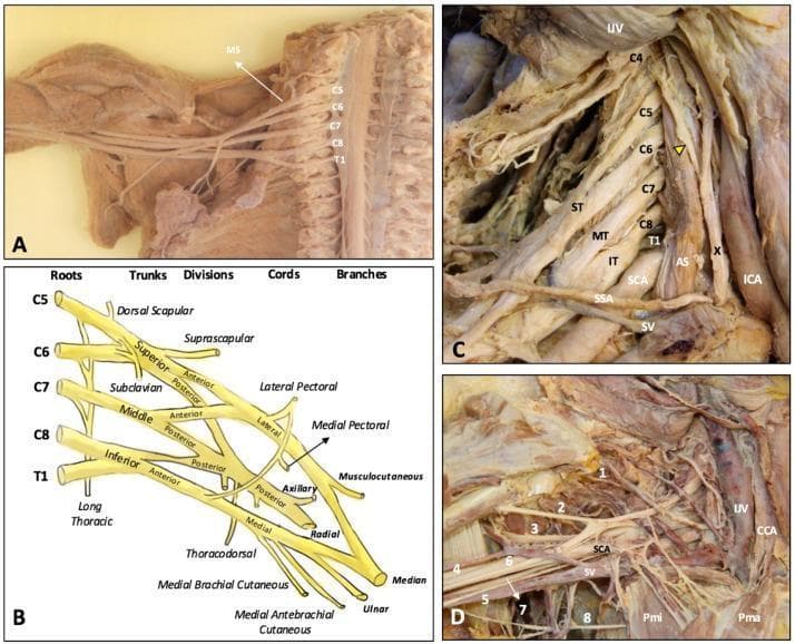 Educational anatomical resource illustrating the brachial plexus through cadaveric dissections (Panels A, C, D) and a schematic diagram (Panel B). Panel A shows the overview of the plexus and middle scalene muscle (MS) relative to the spinal cord. Panel B provides a detailed schematic of the classical brachial plexus organization: roots (C5-T1), superior (ST), middle (MT), and inferior (IT) trunks, anterior and posterior divisions, cords (lateral, medial, posterior), and terminal branches. Panel C displays a deep neck dissection highlighting the relationship between roots C4-T1 and the anterior scalene (AS), subclavian artery (SCA), internal jugular vein (IJV), and vagus nerve (X). A yellow arrowhead identifies the phrenic nerve. Panel D focuses on the infraclavicular and axillary regions, showing terminal branches: 1 (suprascapular), 2 (musculocutaneous), 3 (axillary), 4 (radial), 6 (median), and 7 (ulnar) nerves. Vascular landmarks include the common carotid artery (CCA) and subclavian vein (SV), alongside the pectoralis major (Pma) and minor (Pmi) muscles, providing clinical context for regional anesthesia and surgical approaches.