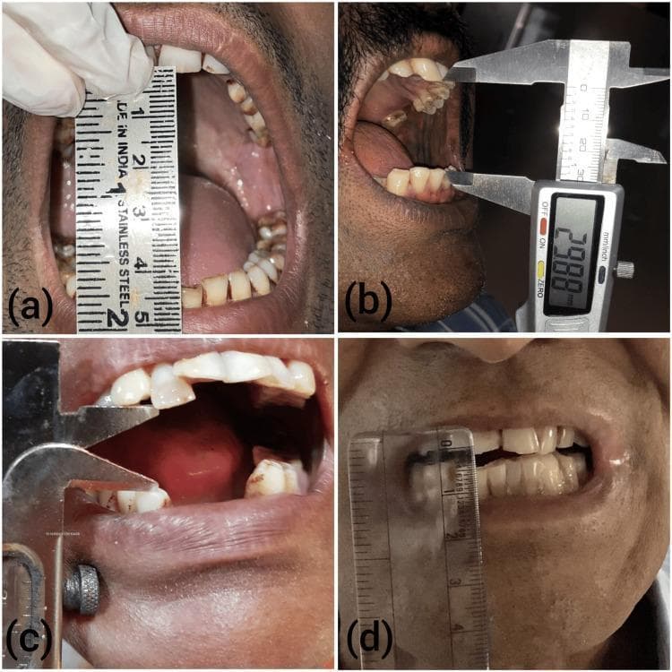 A composite of four clinical photographs (a-d) demonstrating the progressive stages of trismus (restricted mouth opening) in patients with Oral Submucous Fibrosis (OSMF). The images illustrate the clinical measurement of maximum interincisal distance using different tools: (a) a vertical stainless steel ruler, (b) a digital caliper showing a measurement of 29.88 mm, (c) a manual vernier-style caliper, and (d) a transparent plastic ruler. The series depicts a clear reduction in the oral aperture from stage I to advanced stage IV. Key visible features include blanched, pale, and opaque oral mucosa in the later stages, which replaces the healthy pink vascular appearance seen in earlier stages. The alignment of the teeth and the health of the gingiva are increasingly difficult to visualize as the disease progresses and the interincisal gap narrows. This progression highlights the fibrous band formation characteristic of OSMF, leading to significant functional impairment in jaw mobility.