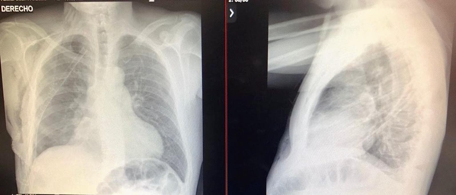 Postoperative chest radiography in anteroposterior (AP) and lateral projections following the resection of a large pleural mass. The AP view (left) demonstrates bilateral lung re-expansion with clear lung parenchyma and no residual radiopaque masses. The mediastinal contour and heart size are within normal limits, and the trachea is midline. Both costophrenic and cardiophrenic angles are sharp and well-defined, indicating the absence of pleural effusion. The lateral view (right) confirms pulmonary expansion with clear retrosternal and retrocardiac spaces. The diaphragmatic domes are smooth and distinct. Bony structures, including the ribs, sternum, and vertebrae, appear intact. Surgical sutures or clips from the previous thoracotomy are visible in the right hemithorax. This diagnostic imaging serves as a clinical baseline to confirm successful surgical intervention and recovery of respiratory function in a patient previously diagnosed with a large solitary fibrous tumor of the pleura.