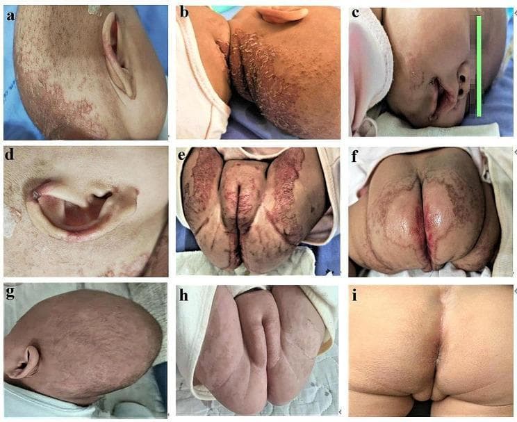 A series of nine clinical photographs (a-i) illustrating the cutaneous manifestations and therapeutic response of acrodermatitis enteropathica-like lesions in an infant. Images a-f depict the pre-treatment state, characterized by well-demarcated, erythematous, and erosive plaques with overlying scaly crusts and scabs. The distribution is classic for zinc deficiency, primarily affecting the acral and periorificial regions: occipital scalp (a, b), perioral area (c), auricle (d), and the perineal and perianal zones (e, f). Diffuse alopecia and sparse hair growth are also visible on the scalp. Images g-i demonstrate the clinical status after 6 days of oral zinc supplementation, showing rapid and significant improvement. The inflammatory erythema and erosions on the scalp (g) and anogenital region (h, i) have largely resolved, leaving behind smooth skin with minimal residual post-inflammatory changes. This comparison serves as a pedagogical tool for recognizing the diagnostic distribution of zinc deficiency-related dermatitis and its dramatic response to targeted replacement therapy.