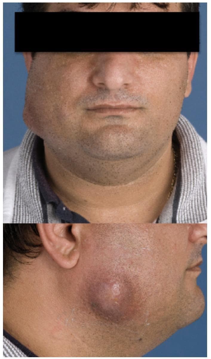 This clinical photograph consists of two views (frontal and profile) demonstrating a significant soft tissue swelling on the left cheek of an adult patient. The swelling is localized to the buccal and parotid-masseteric regions, appearing as a rounded, protruding mass. In the profile view, the lesion exhibits characteristic signs of cervicofacial actinomycosis, including erythematous to violaceous skin discoloration and a central indurated area with an incipient sinus tract formation. This pinpoint area of skin breakdown suggests the classic 'lumpy jaw' presentation where chronic granulomatous inflammation lead to the formation of abscesses and draining fistulas. The educational focus is on identifying the clinical morphology of cervicofacial actinomycosis, specifically the presence of a chronic, painless or slightly tender swelling that may eventually develop external drainage pathways. This visual is typical for dental or oral surgery curricula regarding deep space neck infections and chronic bacterial infections.