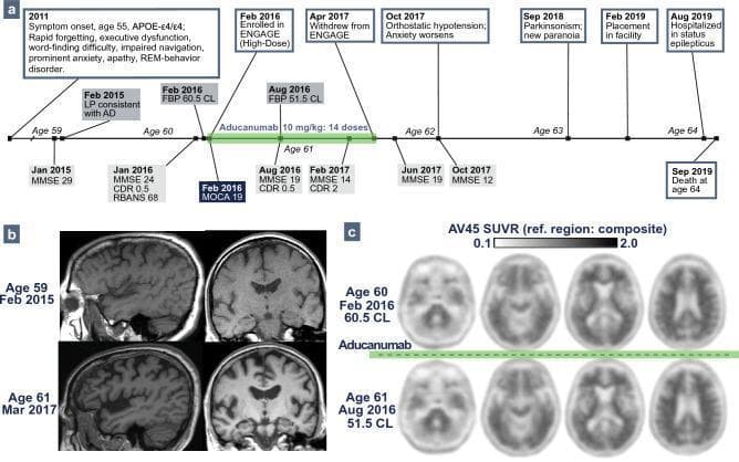 Educational medical graphic presenting the clinical and neuroimaging progression of a patient with early-onset Alzheimer's disease (AD) and comorbid Lewy body disease. Section 'a' displays a clinical timeline from age 55 to 64, tracking MMSE/CDR scores and symptoms like memory loss, Parkinsonism, and death in status epilepticus. Section 'b' contains T1-weighted MRI scans in sagittal and coronal views, showing longitudinal brain atrophy over two years (ages 59 to 61); notable features include progressive widening of the cortical sulci and enlargement of the lateral ventricles (ventriculomegaly), indicating loss of cortical and subcortical volume. Section 'c' presents Florbetapir (AV45) PET scans quantifying amyloid plaque burden. Axial slices show a comparison before and after Aducanumab treatment, with Centiloid (CL) values decreasing from 60.5 to 51.5. This reduction in radiotracer uptake intensity suggests a decrease in cortical amyloid load despite the patient's continued clinical decline. The material is intended for advanced medical education in neurology and neuroradiology, illustrating the dissociation between biomarker reduction and clinical outcomes in complex neurodegenerative profiles.