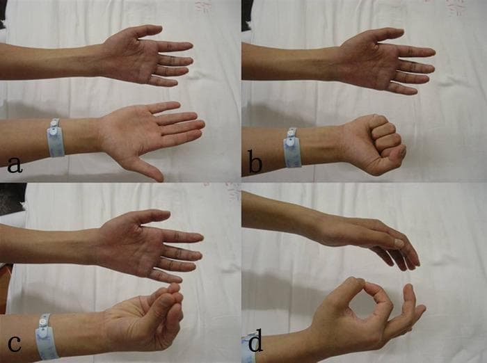 This set of four clinical photographs (a-d) demonstrates a significant neurological motor deficit in a patient's left hand, compared against a healthy right hand for reference. The images illustrate a clinical presentation of lower brachial plexus injury, specifically C8-T1 nerve root avulsion. Image (a) shows the patient attempting extension; image (b) depicts a failure to form a fist, indicating M0 strength in the extrinsic finger flexors; image (c) shows an inability to flex the thumb and index finger; and image (d) shows an incomplete 'O' sign, representing a failure of thumb-index finger opposition. The visual findings emphasize a total loss of digit flexion, opposition, and intrinsic hand muscle function, characteristic of Klumpke's palsy or severe lower plexus trauma. These clinical signs are used in neurosurgical and orthopedic contexts to assess the severity of peripheral nerve injuries and to plan reconstructive procedures like nerve transfers or functional muscle grafts.