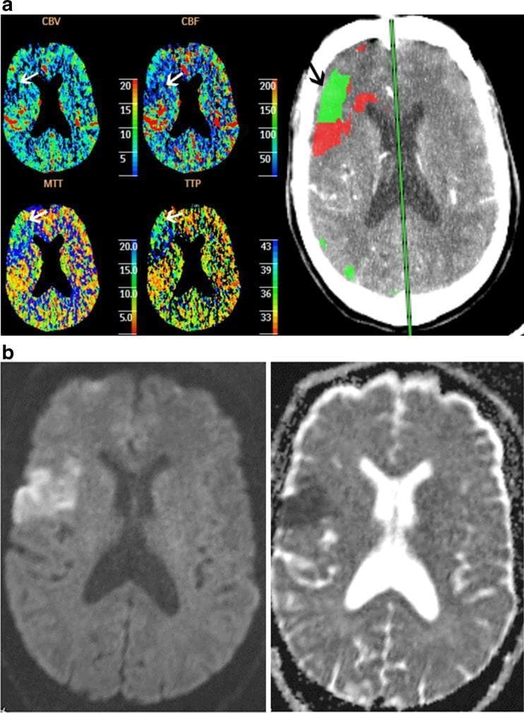 Educational diagnostic imaging series demonstrating acute cerebral infarction evaluation using CT Perfusion (CTP) and MRI. (a) Axial CTP maps (CBV, CBF, MTT, and TTP) show a perfusion deficit in the right middle cerebral artery (MCA) territory, indicated by open arrows. The area of abnormality progressively increases from CBV to TTP, illustrating a perfusion mismatch. A large-scale computer-generated lesion map (closed arrow) identifies a 'mixed lesion' with red indicating the infarct core (decreased CBV) and green representing the ischemic penumbra (elevated MTT with normal CBV). (b) Follow-up MRI performed 4 hours later includes Diffusion-Weighted Imaging (DWI) and an Apparent Diffusion Coefficient (ADC) map. These confirm an acute infarct in the right hemisphere, characterized by high signal on DWI and corresponding low signal on ADC, matching the initial CBV deficit on CTP. The image serves to teach the concepts of infarct core versus penumbra and the correlation between CTP parameters and definitive MRI evidence of ischemia.