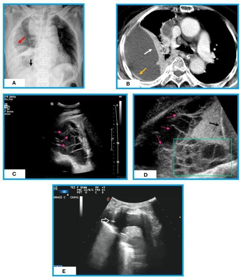 A multi-modal comparison of complex pleural effusion in a patient with post-primary tuberculosis across three imaging modalities. (A) Chest X-ray (CXR) depicts a non-gravity-dependent right pulmonary opacity with medial visualization of the diaphragm. (B) Contrast-enhanced axial CT of the chest shows a large, loculated right pleural collection with visceral pleural thickening (split-pleura sign) and adjacent compressive lung atelectasis; however, internal septations are poorly visualized. (C, D) Thoracic ultrasound (TUS) provides superior visualization of the effusion's internal architecture, showing multiple hyperechoic, linear, and mobile fibrin strands forming complex septations and loculations. (E) Real-time TUS-guided thoracentesis demonstrates a hyperechoic needle tip successfully placed within an anechoic fluid pocket. This educational series illustrates the diagnostic strengths of various modalities: CXR and CT for global assessment and pleural morphology, and TUS for identifying fibrin-rich, complex internal structures and facilitating safe procedural guidance in organized exudative effusions.