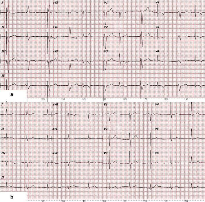 A comparative 12-lead electrocardiogram (ECG) showing cardiac rhythm changes before and after atrial lead implantation. Panel (a) displays a rhythm with intermittent ventricular pacing (VVI mode). It features wide, bizarre QRS complexes (1st–4th, 6th, 8th, and 10th beats) indicative of ventricular pacing spikes and subsequent ventricular depolarization, interspersed with narrower, intrinsic QRS complexes (5th, 7th, 9th–11th beats). There is a notable lack of consistent atrioventricular (AV) synchrony in this panel. Panel (b) demonstrates the results of dual-chamber pacing (AAI/DDD mode) after new atrial lead placement. This strip shows restored AV synchrony, where each atrial deflection (P-wave) is consistently followed by a narrow, intrinsic ventricular deflection. This comparison illustrates the transition from asynchronous ventricular pacing to synchronized atrial-driven ventricular activation, highlighting the resolution of AV desynchronization. Key clinical concepts shown include pacing morphology, intrinsic conduction, and the importance of AV synchrony in pacemaker management.