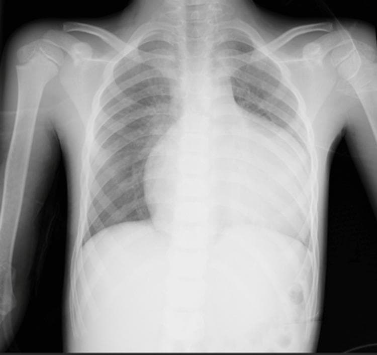 This diagnostic image is a posterior-anterior (PA) chest radiograph of a pediatric patient demonstrating severe pathology. The most prominent finding is massive cardiomegaly, with the cardiac silhouette occupying a significantly increased cardiothoracic ratio, nearly filling the lower half of the thoracic cavity. This global enlargement is consistent with advanced congenital heart disease, such as Ebstein's anomaly. Additionally, the bilateral hilar regions exhibit increased vascular density and indistinctness, characteristic of pulmonary hilar congestion and venous hypertension. The lung fields show prominent vascular markings extending from the hila, though the peripheral lung zones remain relatively clear. The bony structures, including the ribs and clavicles, appear developmentally appropriate for a child. This radiograph serves as a critical educational example of extreme cardiac remodeling and secondary pulmonary vascular changes resulting from chronic volume overload and right-sided heart failure.