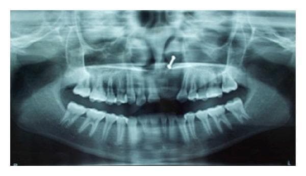 An orthopantomograph (OPG) or panoramic dental radiograph providing a comprehensive view of the maxilla, mandible, and associated dental structures. The image shows the bilateral temporomandibular joints, maxillary sinuses, nasal cavity, and alveolar processes. In the anterior maxilla (upper left quadrant), there is a notable absence of tooth 21 and tooth 22. In the region of the missing tooth 22, a diffuse, ill-defined area of radiolucency is visible, suggesting localized bone loss or a pathological lesion consistent with inflammatory fibrosis or a cystic process. The adjacent teeth show relatively normal root morphology, though there is evidence of generalized mild horizontal bone loss. A small, curved radiopaque artifact is visible in the midline area above the anterior maxillary teeth. This diagnostic image is significant for evaluating dental spacing, alveolar bone density, and the secondary effects of tooth extraction or localized soft tissue pathology in oral surgery and clinical dentistry.