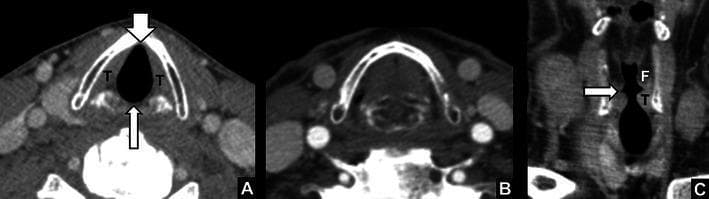 Diagnostic CT imaging of the larynx demonstrating the normal anatomy and functional positions of the vocal cords. Figure A shows an axial slice during quiet breathing; the true vocal cords (T) are in a relaxed, abducted state, clearly revealing the anterior commissure (short arrow) and posterior commissure (long arrow). Figure B depicts the same axial level during a breath-hold maneuver, demonstrating the adduction of the true vocal cords to the midline. Figure C provides a coronal reformat, illustrating the vertical spatial relationship within the glottis and supraglottis. The laryngeal ventricle (arrow) is visible as a slit-like lateral recess separating the superiorly located false vocal cords (F) from the inferiorly located true vocal cords (T). These images serve as a baseline for identifying laryngeal pathologies, such as vocal cord paralysis, which manifests as ventricular widening, cord atrophy, or paramedian positioning.