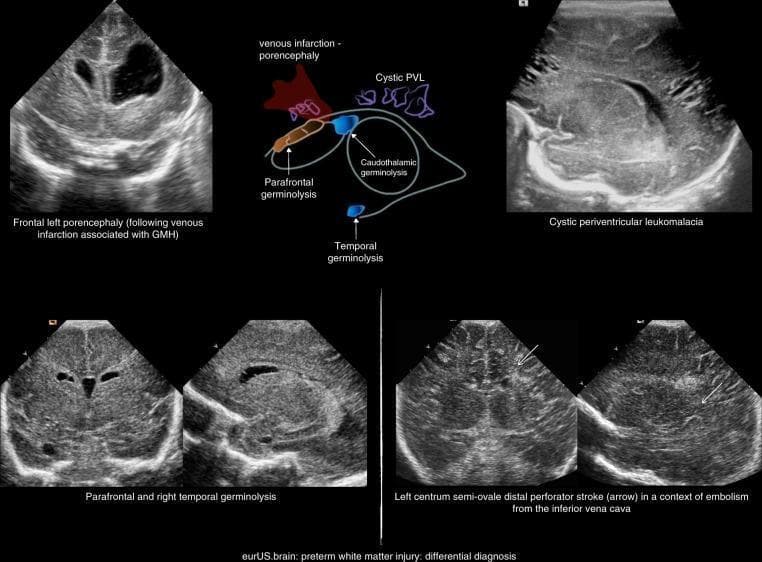This composite educational graphic presents cranial ultrasound (CUS) images demonstrating a differential diagnosis of preterm white matter injury (WMI). The top-left panel shows frontal left porencephaly following venous infarction associated with germinal matrix hemorrhage (GMH). A central schematic diagram maps the locations of venous infarction, cystic periventricular leukomalacia (PVL), and various sites of germinolysis (parafrontal, caudothalamic, and temporal). The top-right CUS image displays cystic PVL, characterized by multiple hypoechoic, fluid-filled cystic spaces in the periventricular white matter, indicating macroscopic focal necrosis. The bottom-left panels illustrate parafrontal and right temporal germinolysis. The bottom-right panels demonstrate a distal perforator stroke in the left centrum semi-ovale, indicated by arrows pointing to focal hypoechoic lesions amidst relatively hyperechoic brain parenchyma. This collection serves to distinguish between different patterns of neonatal brain injury, including localized vascular events and diffuse leukomalacia, emphasizing sonographic morphology and anatomical distribution for clinical classification.