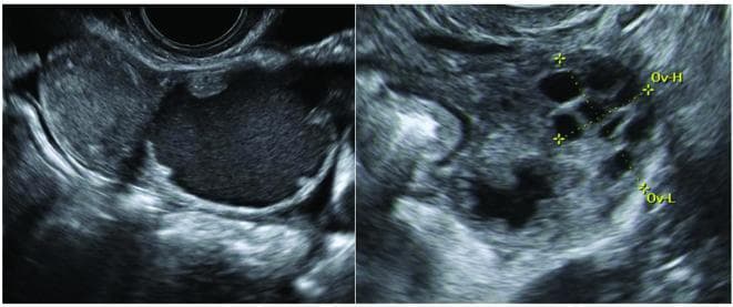 This diagnostic ultrasound image demonstrates classic sonographic features of acute salpingitis in two planes. The left panel shows a longitudinal view of a distended fallopian tube appearing as a pear-shaped unilocular mass with low-level internal echogenicity and thickened walls exceeding 5 mm. The right panel displays a transverse section illustrating the 'cogwheel sign,' characterized by multiple small, round, hypoechoic to anechoic structures arranged in a circular or serrated pattern. These protrusions represent cross-sections of thickened, edematous endosalpingeal folds projecting into the tubal lumen. The structures are bounded by incomplete septae and are adjacent to the ovary, which is marked with calipers (Ov-H and Ov-L). These findings are pathognomonic for inflammatory processes of the fallopian tube, such as pelvic inflammatory disease (PID), and help distinguish tubal pathology from primary ovarian masses.