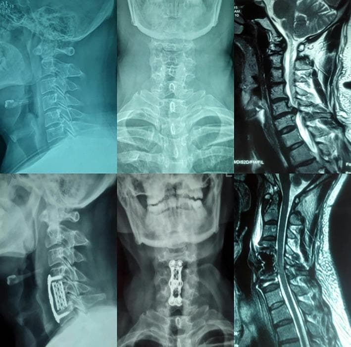 A six-panel medical image composite showing preoperative and postoperative radiographic and MRI views of the cervical spine. The top row displays preoperative status: lateral X-ray, anteroposterior (AP) X-ray, and sagittal T2-weighted MRI, showing cervical spondylosis and intervertebral disc narrowing. The bottom row presents postoperative imaging after anterior cervical decompression and fusion (ACDF): a lateral X-ray (left) shows a radiopaque metallic anterior cervical plate and screw system spanning two motion segments, with an interbody cage visible; an AP X-ray (center) displays the rectangular plate with a central perspective window and four-screw fixation; and a sagittal MRI (right) shows the decompressed spinal canal. The titanium alloy hardware appears as highly radiopaque structures on X-ray and signal voids on MRI. This visual demonstrates surgical stabilization using a dynamic anterior cervical nail plate system for multilevel cervical spine pathologies.