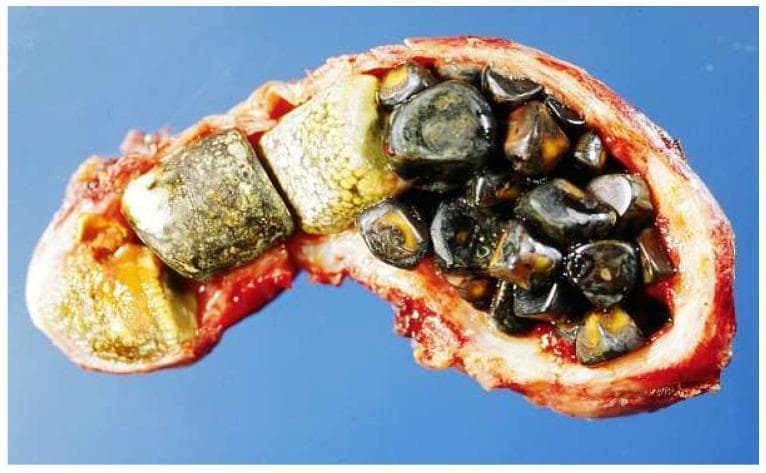 This clinical photograph shows a gross pathology specimen of a human gallbladder that has been surgically incised and opened longitudinally to reveal an internal cavity densely packed with cholelithiasis (gallstones). The gallbladder wall appears thickened and erythematous, consistent with chronic cholecystitis or biliary stasis. The stones present a polymorphic appearance: a subset of larger, faceted, yellowish-tan stones likely composed primarily of cholesterol are visible on the left, while the right portion of the lumen is filled with numerous smaller, dark brown to black, ovoid pigment stones containing bilirubin. The variety in morphology and coloration suggests a mixed-composition stone profile. This image illustrates severe cholelithiasis, demonstrating how calculi can completely fill the gallbladder lumen, potentially leading to obstruction, inflammation, and infection. This visual is suitable for medical education regarding gastrointestinal pathology and surgical anatomy of the biliary system.