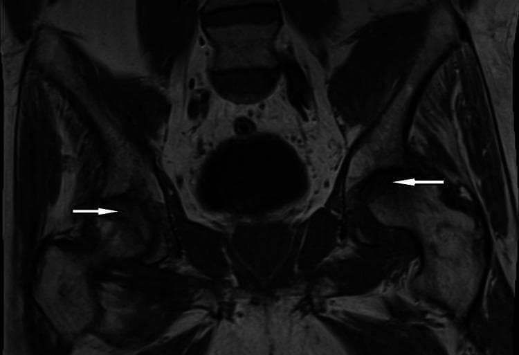 Coronal T1-weighted MRI of the pelvis demonstrating bilateral osteonecrosis (avascular necrosis) of the femoral heads. The image reveals heterogeneous signal intensity and irregular morphology within both femoral heads. White arrows highlight areas of subchondral collapse, which is most pronounced on the left side, where there is a clear loss of the normal spherical contour of the femoral head. These findings are consistent with advanced-stage osteonecrosis leading to articular surface fragmentation and secondary degenerative joint disease (osteoarthritis) of the hip. The pelvic girdle, including the acetabula and surrounding soft tissues, shows signs of chronic remodeling associated with altered joint mechanics. This diagnostic image serves as a clinical example of the progression from bone marrow ischemia to structural joint failure in a patient with systemic risk factors such as hemochromatosis.