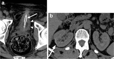 This composite of axial non-contrast computed tomography (CT) images illustrates secondary complications of chronic neurogenic bladder in a patient with a long-term spinal cord injury (SCI). Image (a) focuses on the pelvic region, demonstrating a small-capacity, thick-walled urinary bladder (white arrowheads), consistent with detrusor hyperactivity. A high-attenuation suprapubic indwelling catheter (white arrow) is positioned within the bladder lumen. Posterior to the bladder, the rectum is significantly distended with mottled fecal material (black arrowheads), indicating fecal impaction, a common manifestation of neurogenic bowel. Image (b) presents an axial slice of the upper abdomen showing the kidneys. The right kidney exhibits focal renal cortical scarring (white arrow), visualized as a peripheral indentation and loss of parenchymal volume. These findings highlight the chronic genitourinary and gastrointestinal sequelae of SCI, specifically the impact of long-term catheterization and dysfunctional voiding/elimination patterns on the urinary tract and bowel.