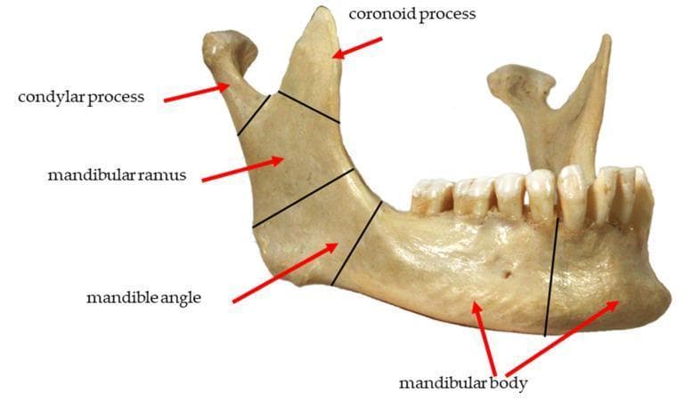 This clinical photograph displays a lateral view of a human mandible, used to illustrate the common anatomical zones for fracture classification. Black demarcating lines and red arrows label five primary regions: 1) The condylar process at the posterosuperior apex, representing the articular portion of the temporomandibular joint. 2) The coronoid process, a sharp, triangular projection anterior to the condyle. 3) The mandibular ramus, the vertical quadrilateral plate connecting the processes to the lower jaw. 4) The mandibular angle, located at the junction of the posterior and inferior borders. 5) The mandibular body, the horizontal portion extending anteriorly and housing the dentition. The image shows the alveolar ridge with integrated teeth and the mental foramen on the lateral surface of the body. This diagram serves as an educational tool for maxillofacial surgery and traumatology, specifically for identifying fracture locations such as subcondylar, ramus, angle, and body fractures.