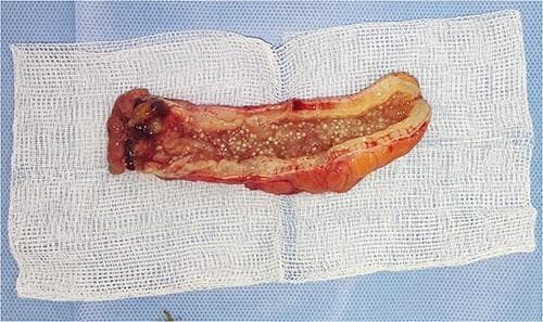 Clinical photograph showing a gross pathological specimen of a surgically resected appendix, which has been longitudinally opened to reveal its contents. The specimen demonstrates the classic presentation of myxoglobulosis, a rare variant of appendiceal mucocele. The oblong structure features a thickened, hyperemic serosal surface and a distended lumen. Key diagnostic features include the presence of numerous small, translucent-to-white, rounded gelatinous globules measuring a few millimeters in diameter, often described as having a 'fish egg' or 'sago grain' appearance. These globules are composed of organized mucin and are distributed throughout the luminal space. One end of the specimen shows areas of dark congestion or hemorrhage. The specimen is displayed on a sterile white gauze pad. This image illustrates the gross morphological findings critical for distinguishing myxoglobulosis from other mucinous neoplasms of the appendix within the context of gastroenterology and surgical pathology.