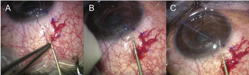 This clinical photographic sequence illustrates the three critical surgical steps of an ab-externo XEN gel stent implantation, a minimally invasive glaucoma surgery (MIGS). Panel A shows the initial conjunctival insertion, where the injector needle is positioned approximately 7 mm posterior to the limbus, stabilized by conjunctival forceps. Panel B depicts the scleral entry phase, with the needle advancing through the scleral tissue approximately 2.5 mm behind the limbus at a shallow angle. Panel C demonstrates the final intraocular positioning, where the injector tip has penetrated into the anterior chamber, visible through the clear cornea. Throughout the procedure, the bulbar conjunctiva shows significant vascular engorgement and localized subconjunctival hemorrhage at the entry sites, which are typical findings. Blue surgical markings on the sclera indicate the measured distances for precise entry. This sequence serves as an educational guide for ophthalmology trainees on the external-to-internal approach for glaucoma drainage device placement.